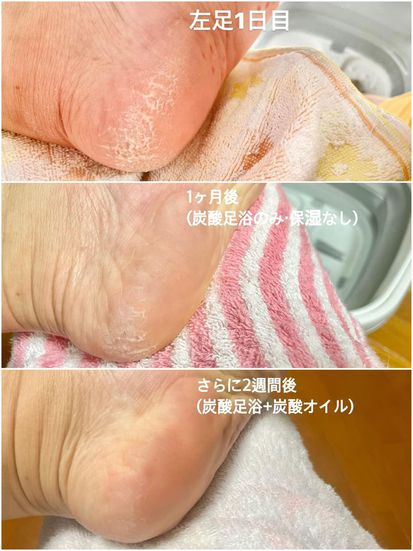 かかとのガサガサ実験の結果 かかとのガサガサ実験の結果