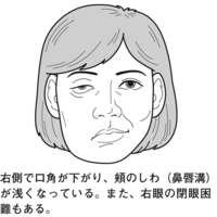 突然のベル麻痺 突然のベル麻痺