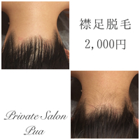 襟足脱毛❤️ 2019/05/08 16:21:21