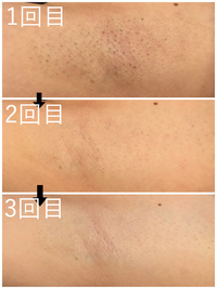 脇脱毛 before & after ✨ 2019/08/27 20:04:34