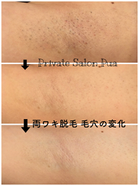 光脱毛で毛穴まで綺麗に✨ 2022/11/01 18:38:08